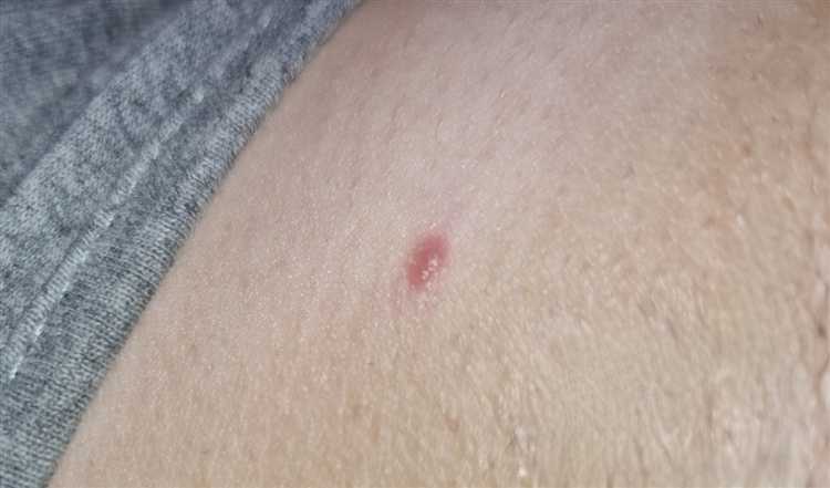 Подготовка пиджака к устранению волдырей: что нужно учесть