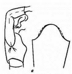 Формирование зубчатого профиля для усиления фиксации