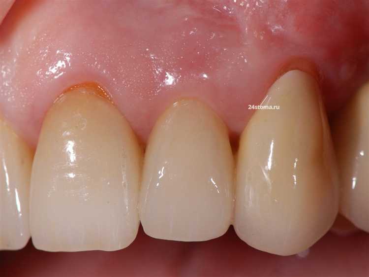 Часто пациенты советуют избегать акций с нереалистично низкой ценой – в отзывах упоминаются случаи замены оригинальных имплантов на аналоги без предупреждения, что впоследствии приводит к осложнениям и повторным вмешательствам.